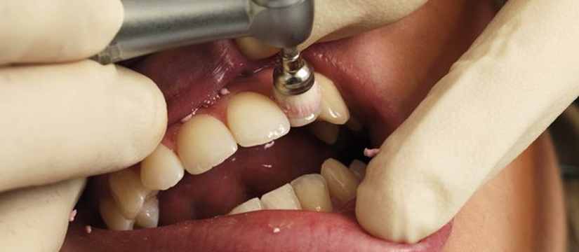 ultrasonic-scaling ultrasonic-scaling