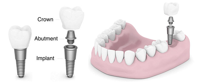 dental-implant dental-implant